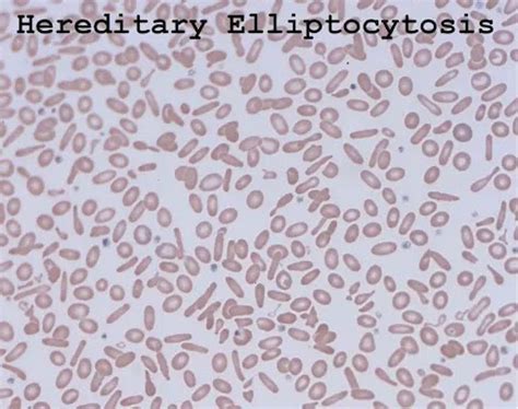 hereditary elliptocytosis life expectancy|Hereditary elliptocytosis .